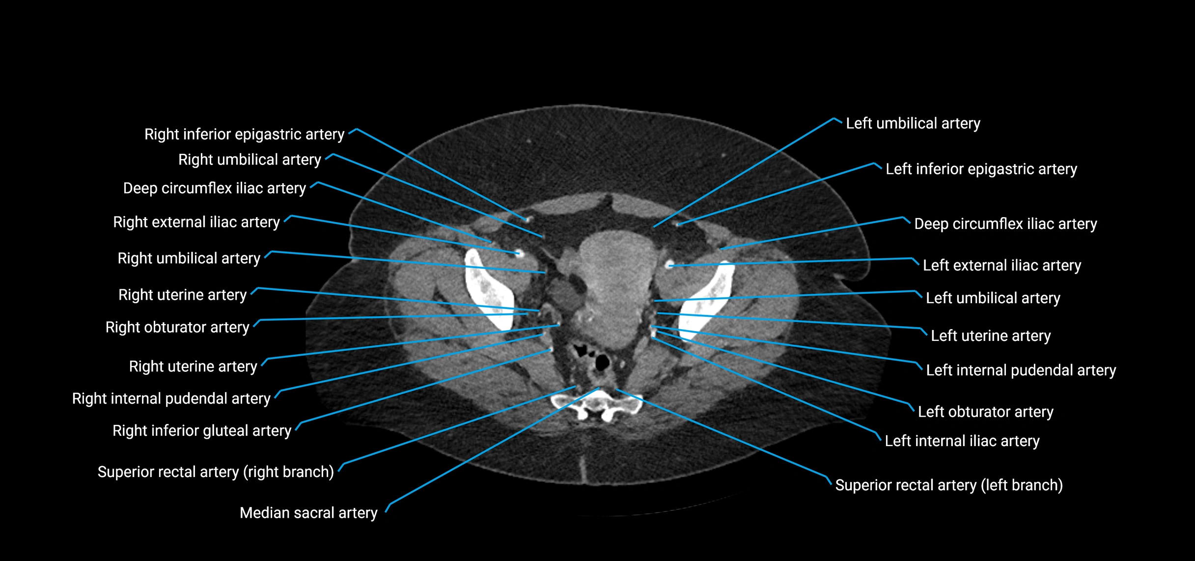 CTA abdomen axial cross sectional anatomy labelled image_219 (2).webp